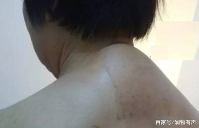 颈椎长个包是怎么回事