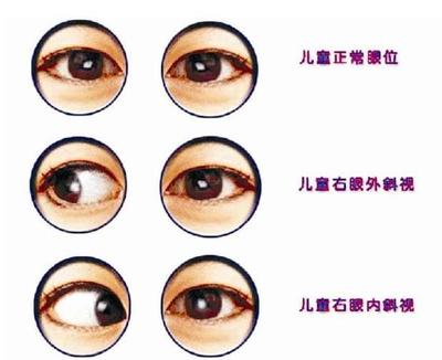 小孩斜视怎么治疗