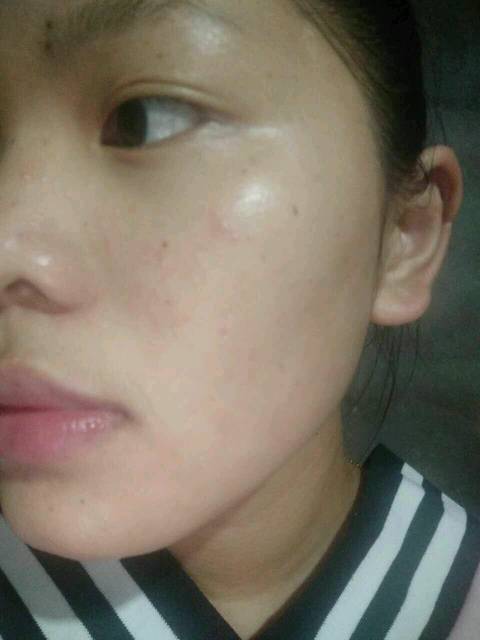 脸上总是有小痘痘