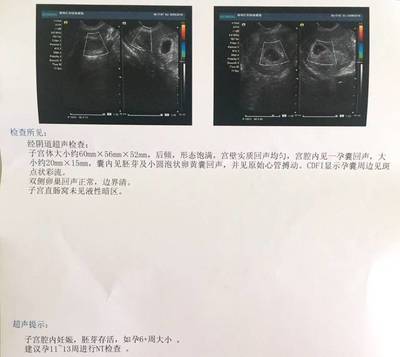 怀孕13周胎心率多少正常