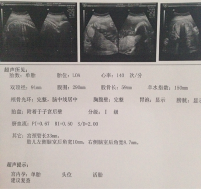 足月胎儿股骨长标准