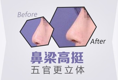 耳软骨隆鼻是永久的吗