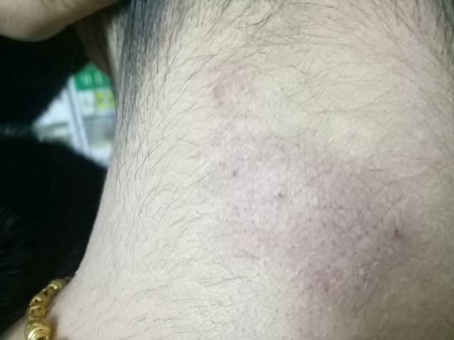 怀孕长癣怎么办