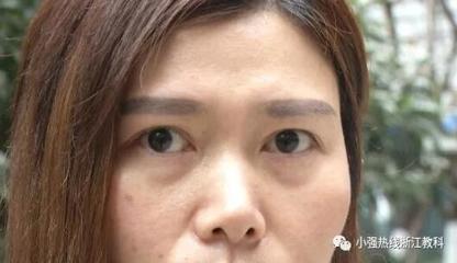 35岁割双眼皮