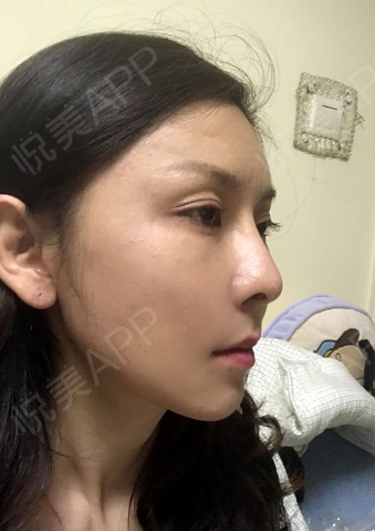 悬吊除皱v美减龄实力