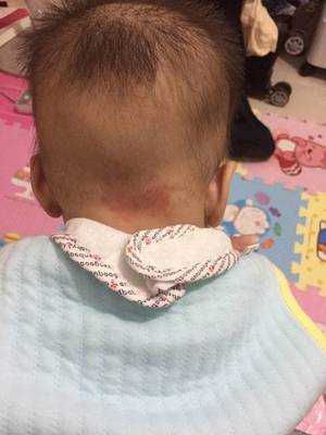 宝宝后脑勺大怎么回事