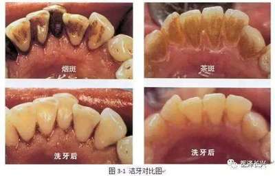 怀孕洗牙齿有影响吗