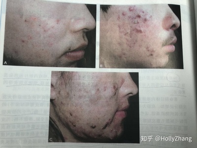 结节囊肿痘痘