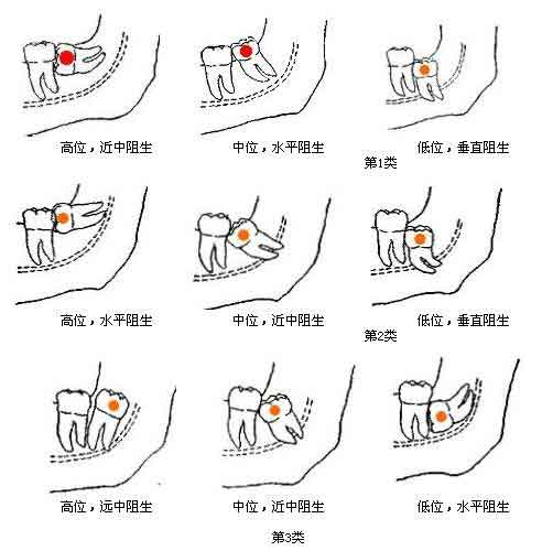什么是等长法