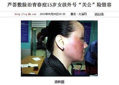 痘痘肌可以用茶叶敷脸吗