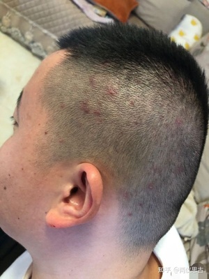 咋样去掉头上的痘痘