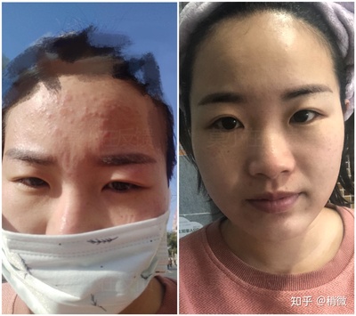 脸过敏痘痘