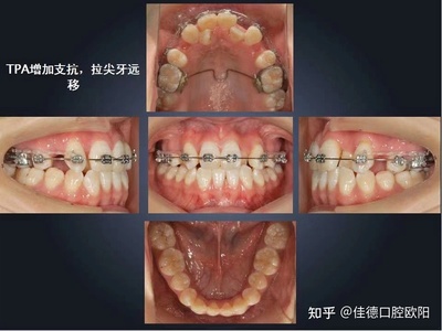 三十岁矫正牙齿要多久