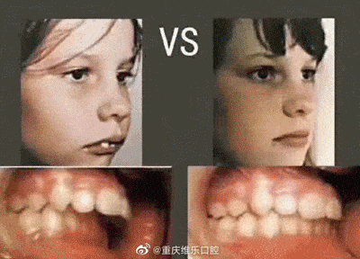 儿童牙齿早期干预