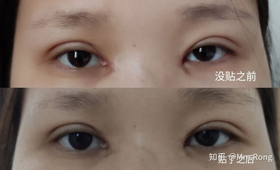 双眼皮什么时候贴