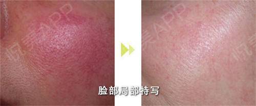 脸部红血丝怎么治