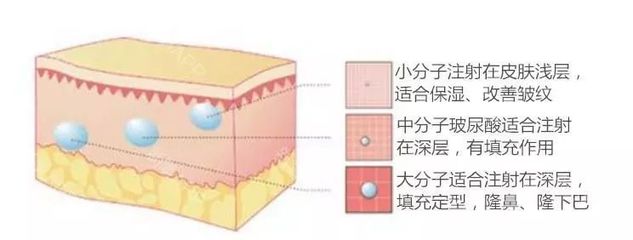 玻尿酸的区别