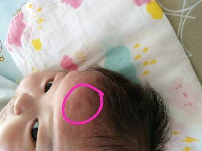 新生儿头后面凹陷图片