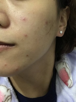 健康水 痘痘