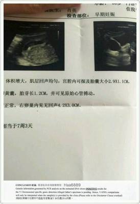 刚怀孕一周会恶心吗