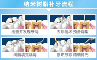 补牙一般要多久