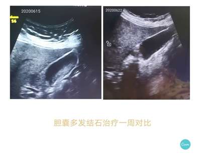 胆囊多发结石该怎么治疗
