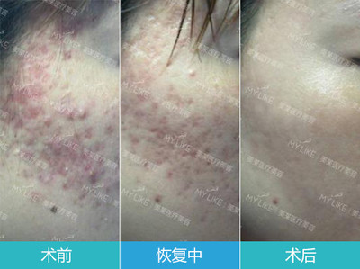 微针美容好不好