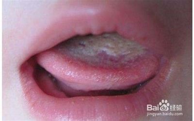 舌苔厚白是怎么回事