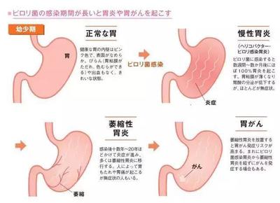 宝宝幽门螺旋杆菌