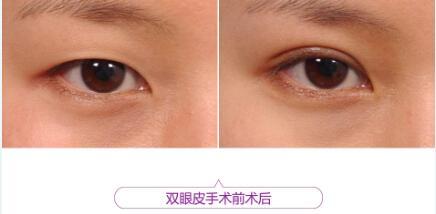 怀孕了能做双眼皮吗