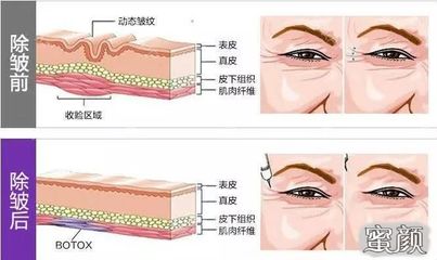 打了除皱针多久见效