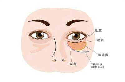 眼部脂肪填充