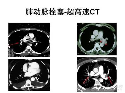 胸痛拍ct要多少钱