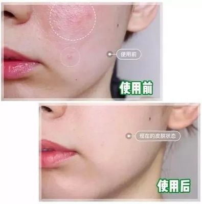 如何让脸上痘痘不复发