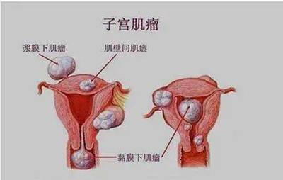 宫颈肿瘤怎么治疗