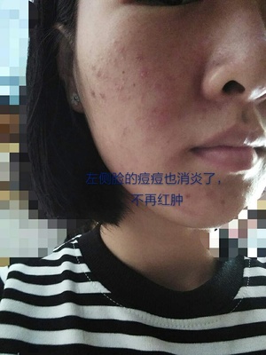 脸上的痘痘怎么消炎