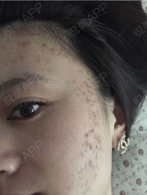 祛痘痘痘印的app软件