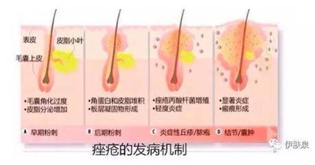 微针炎症痘痘