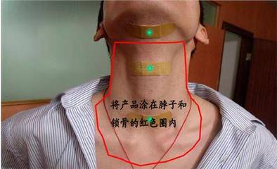 颈部结节怎么治疗