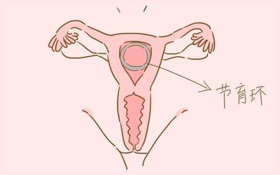 上环久了会影响怀孕吗