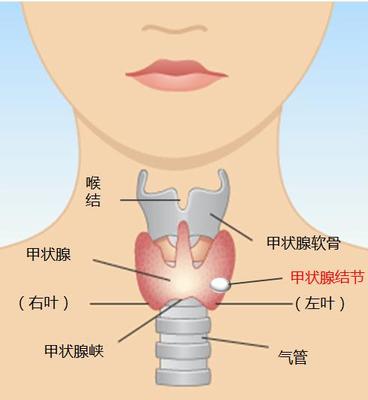 颈部结节怎么治疗