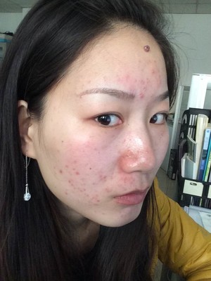 痘痘老是不好_好烦