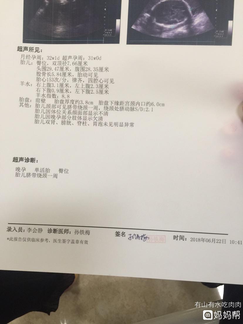 胎儿32周脐带绕颈一周怎么办