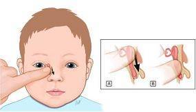 新生儿泪道堵塞的症状