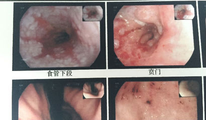 食管炎反复发作怎么办