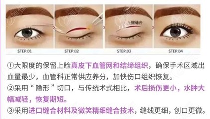割双眼皮修复多少钱