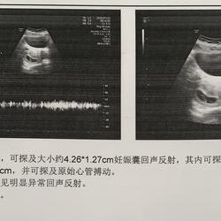 怀孕多久有心管搏动
