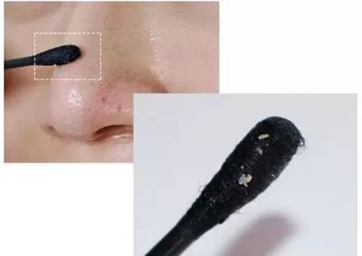 痘痘白头掉了之后