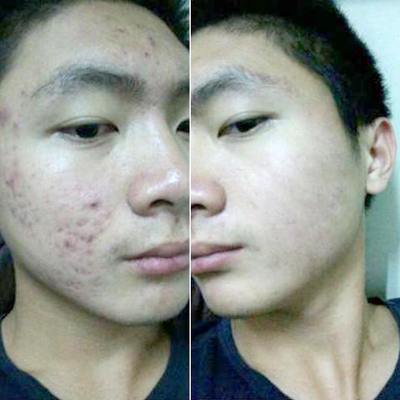 男生经常长痘痘
