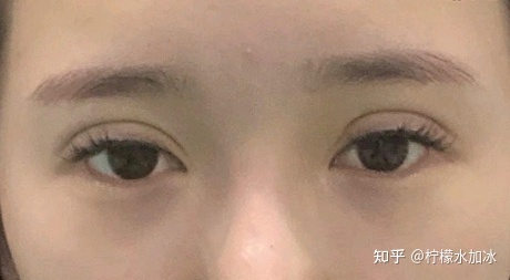 双眼皮自述
